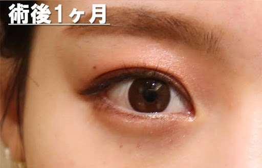 術後1ヶ月