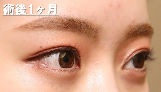 術後1ヶ月
