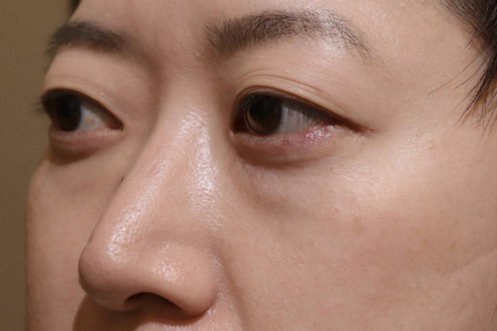 術前　斜め