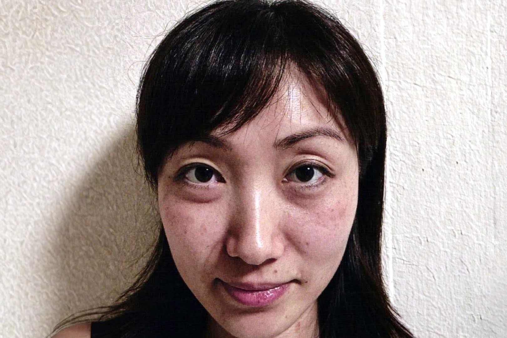 眼症発症前