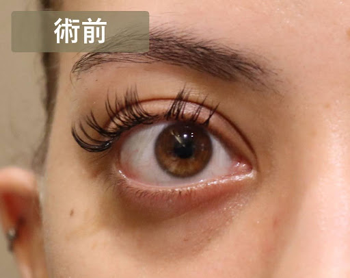術前