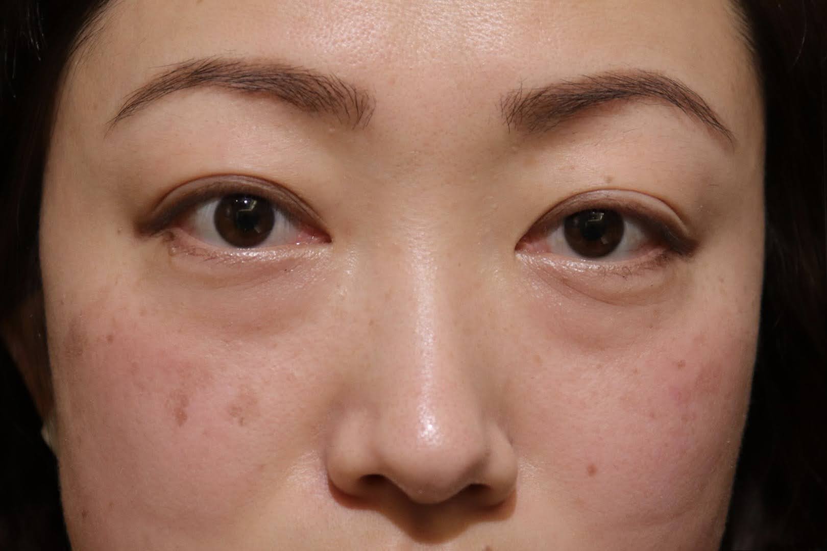 術前　正面