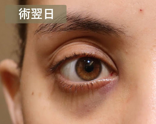術翌日