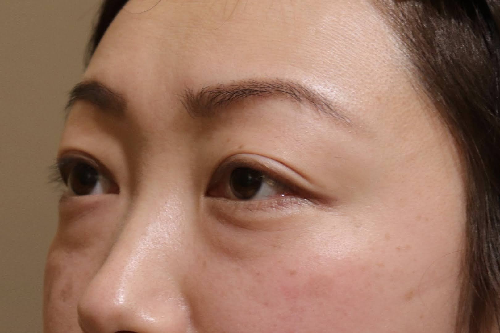 術前　斜め