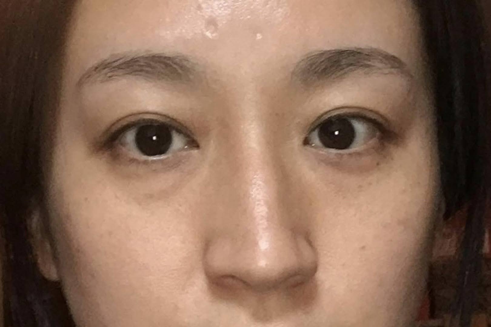 眼症発症前