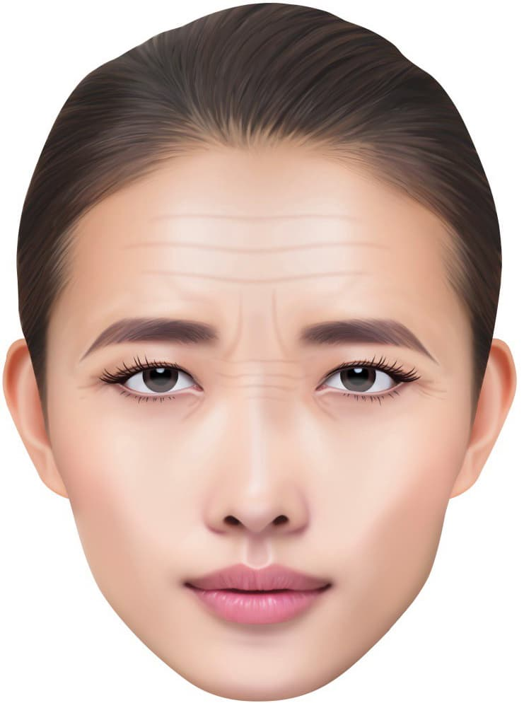 前額リフト(眉リフト) 術前
