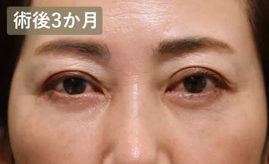 症例4術後3ヶ月正面