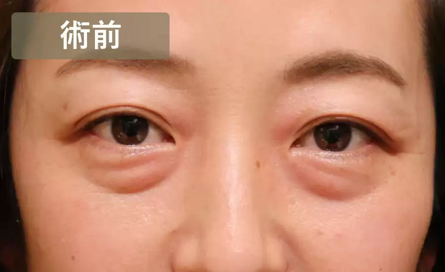 症例1術前正面