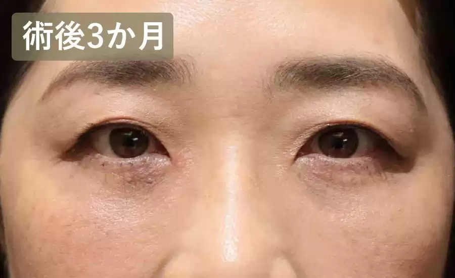 症例2術後3ヶ月