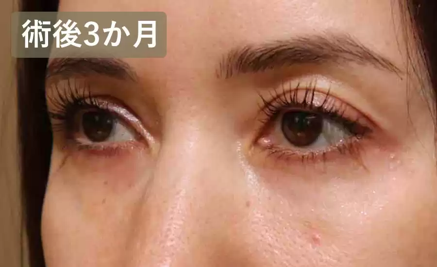 症例3術後3ヶ月横