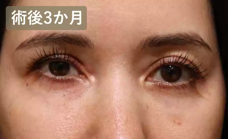 術後3ヶ月正面