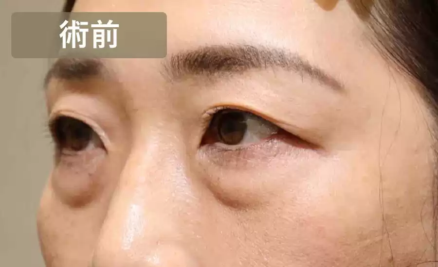 症例2術前横