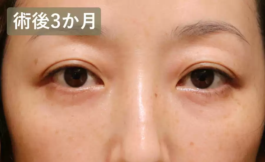 症例1術後3ヶ月正面