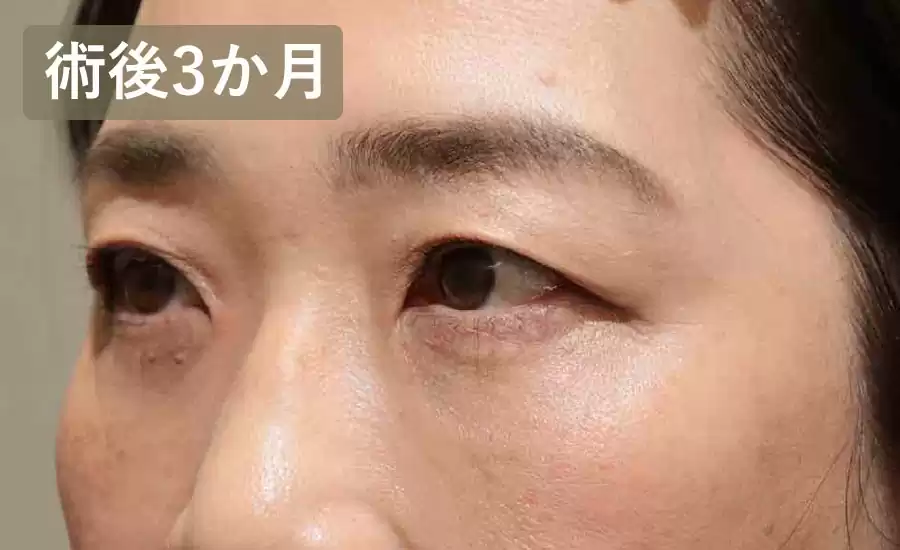 症例2術後3ヶ月横