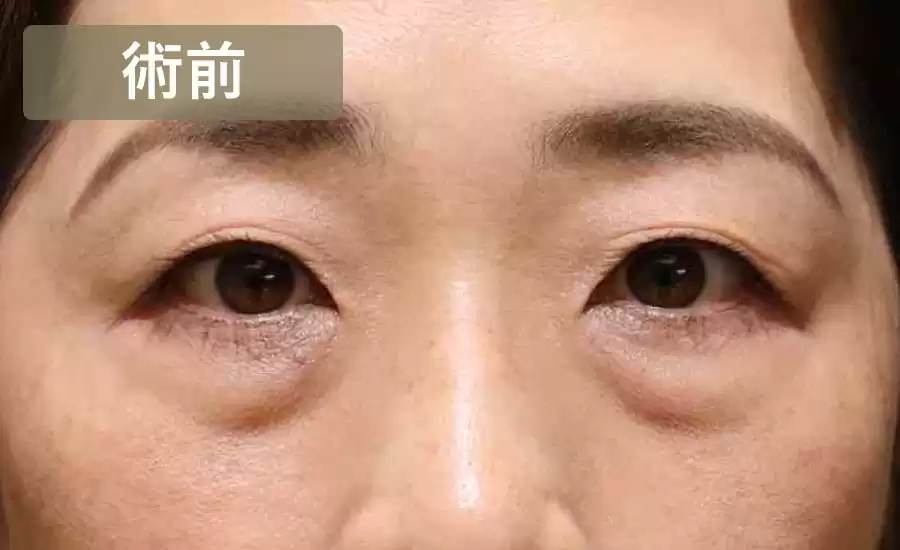 症例2術前正面