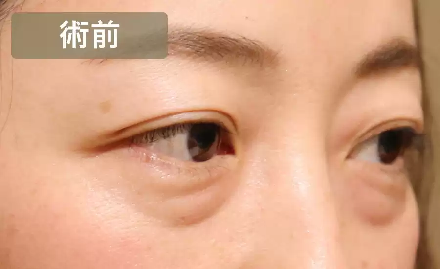 症例1術前横