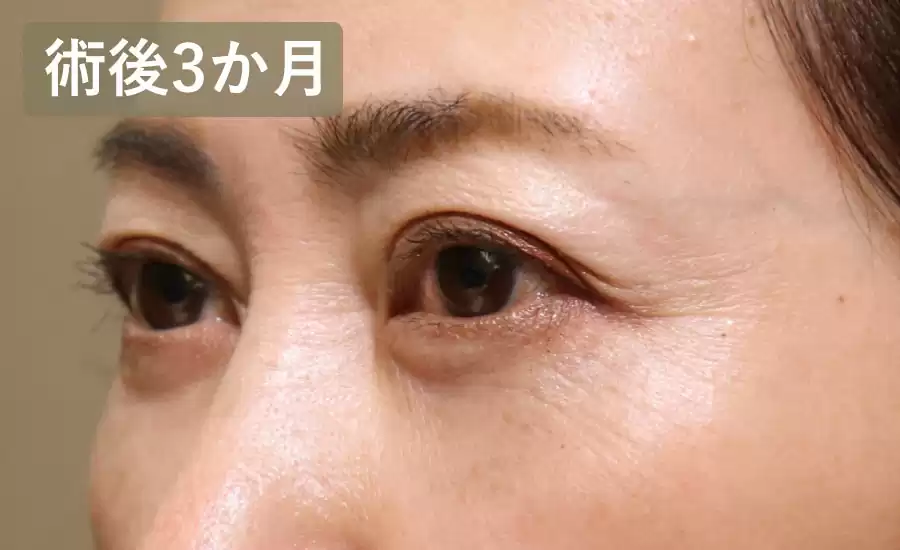 症例術後3ヶ月横